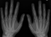 Artritis na rukama